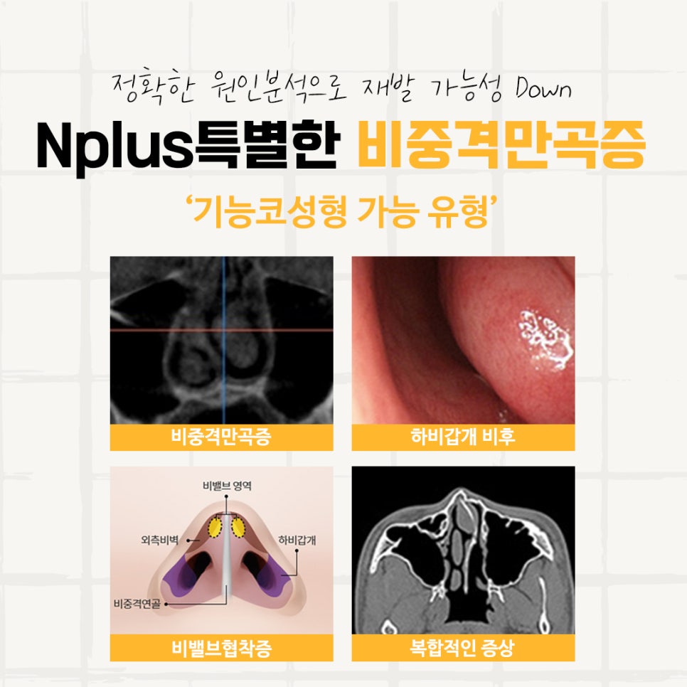 Septoplasty Surgery Review: With a Careful Decision image 5