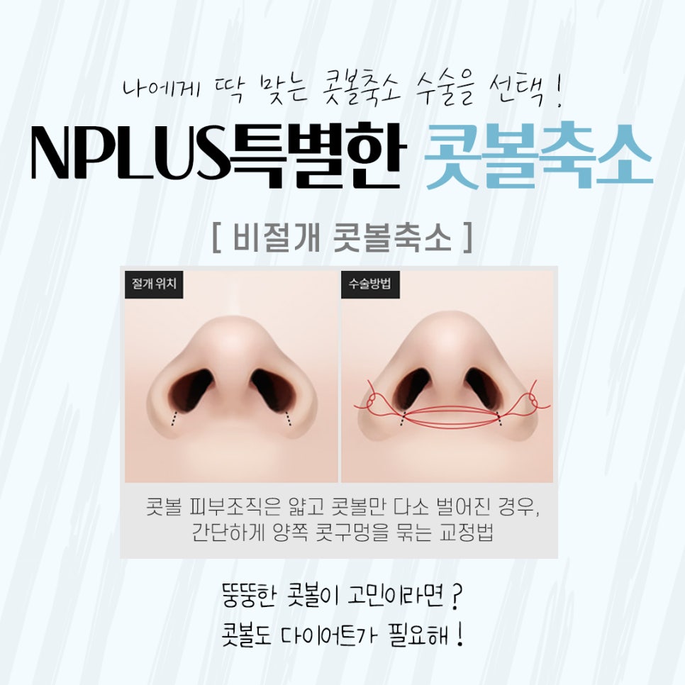 Natural Progress in Nasal Alar Reduction Surgery Review image 8