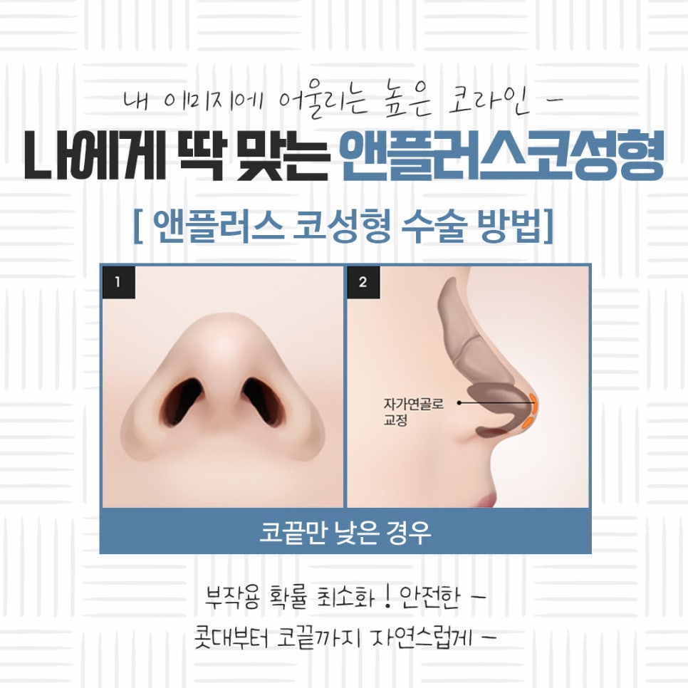 자가연골 이용한 코성형 후기 관련 이미지 10