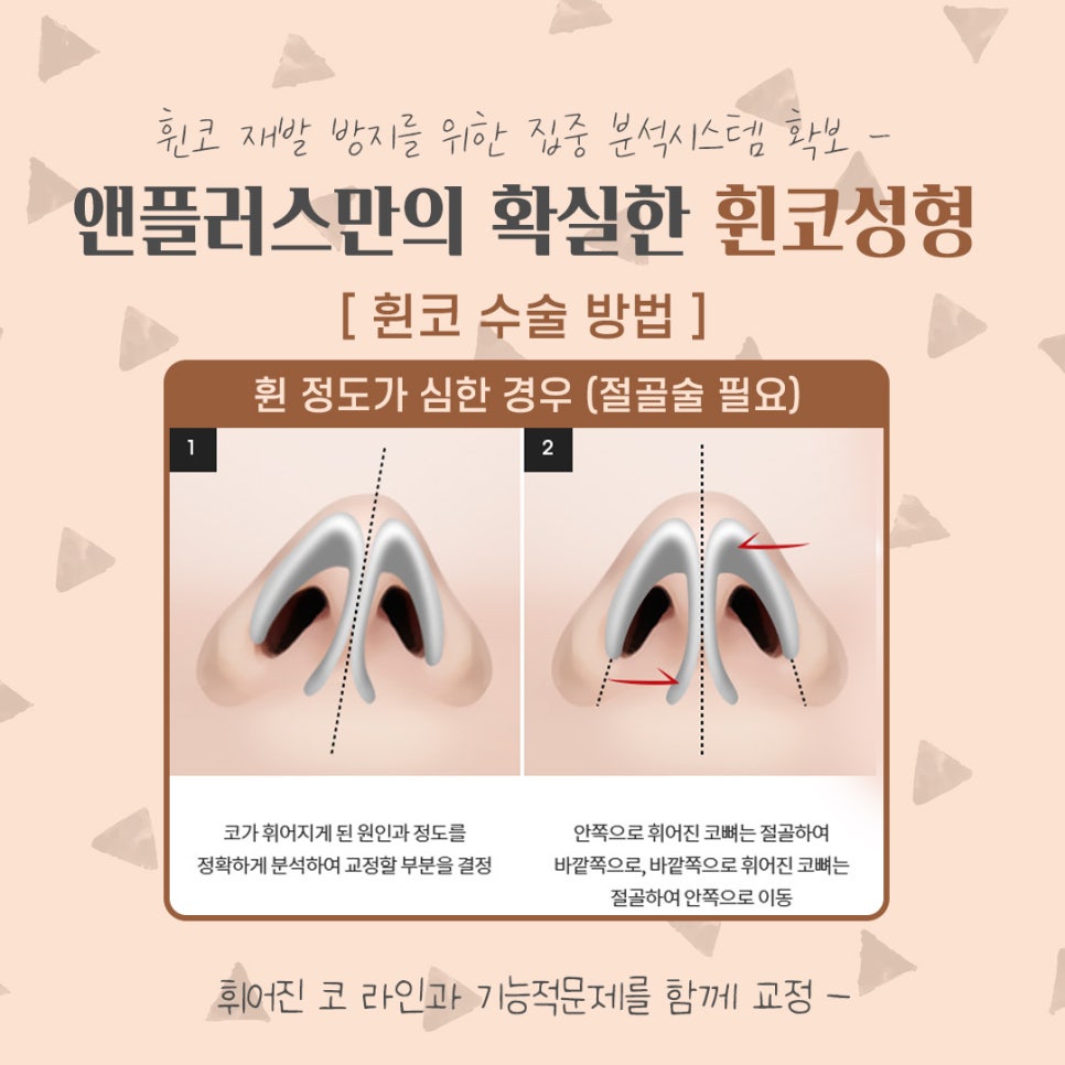 Crooked Nose Surgery Review, Including Functional Improvement image 9