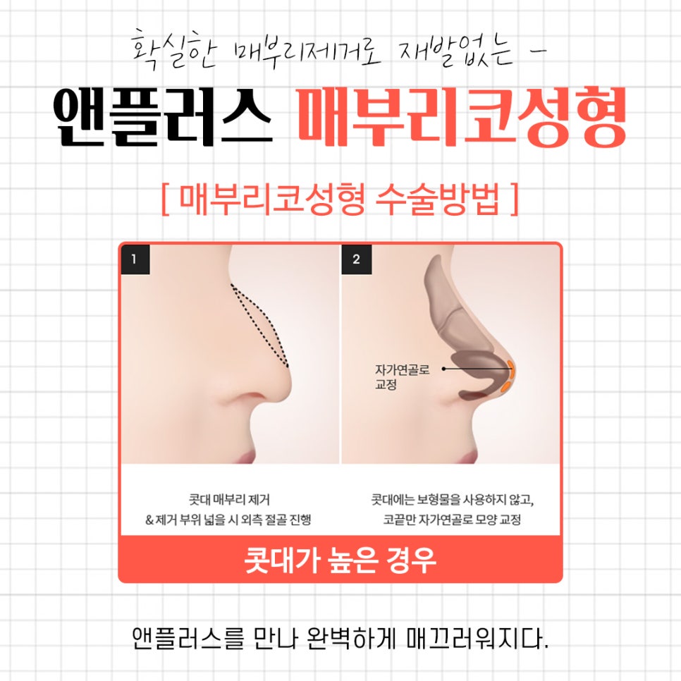 A Complete Guide to the Causes of a Hump Nose and Surgical Methods image 7