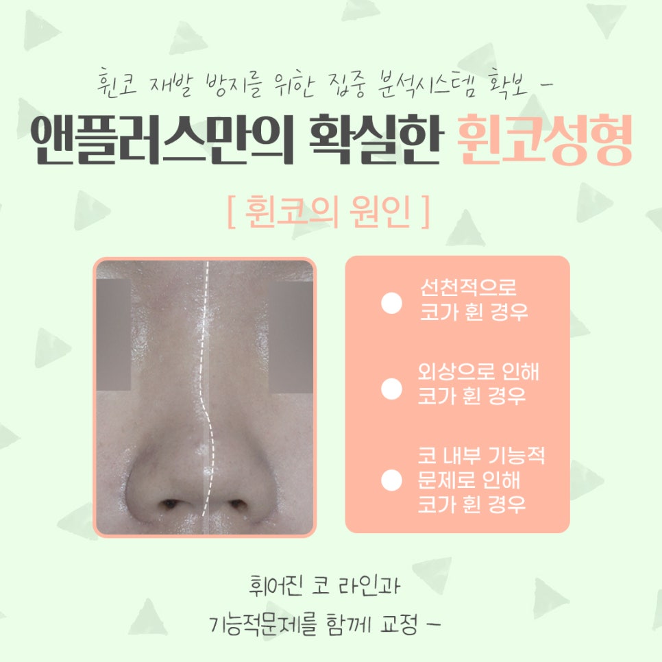 휜코성형후기 자세하게 알아보고 관련 이미지 3