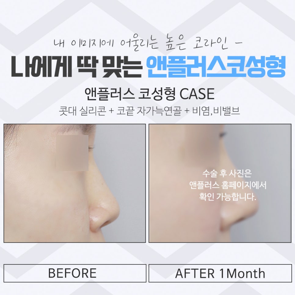 코성형후기를 다양하게 찾아보고 관련 이미지 16