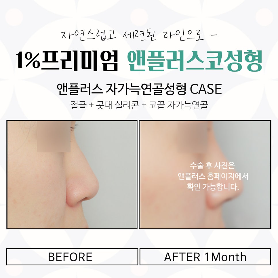 Learn About Autologous Rib Cartilage Nose Surgery Accurately image 16