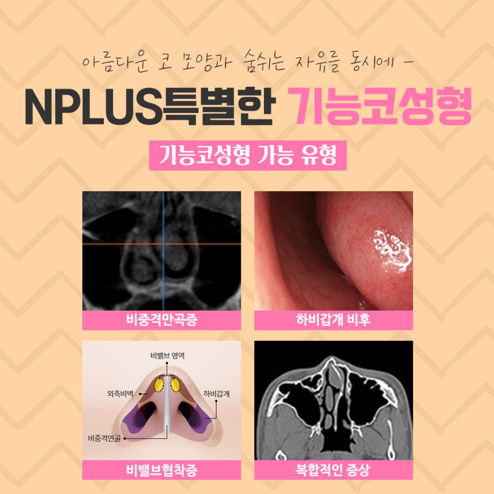 Functional Nose Surgery Reviews with Improved Nasal Line image 6