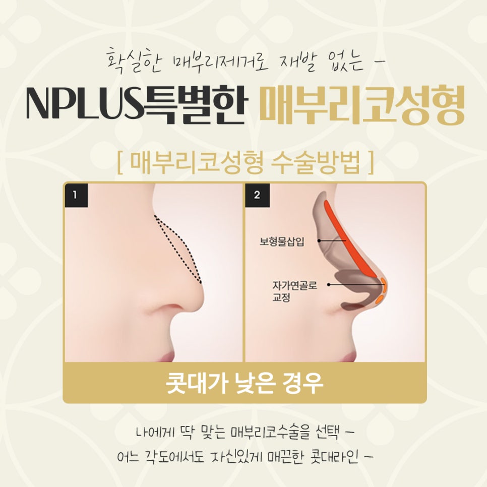 매부리코수술후기 확인하고 부드러운 인상으로 관련 이미지 11
