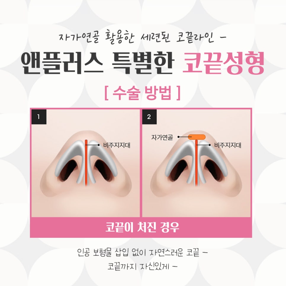 코끝수술후기의 다양함을 알아보고 관련 이미지 9