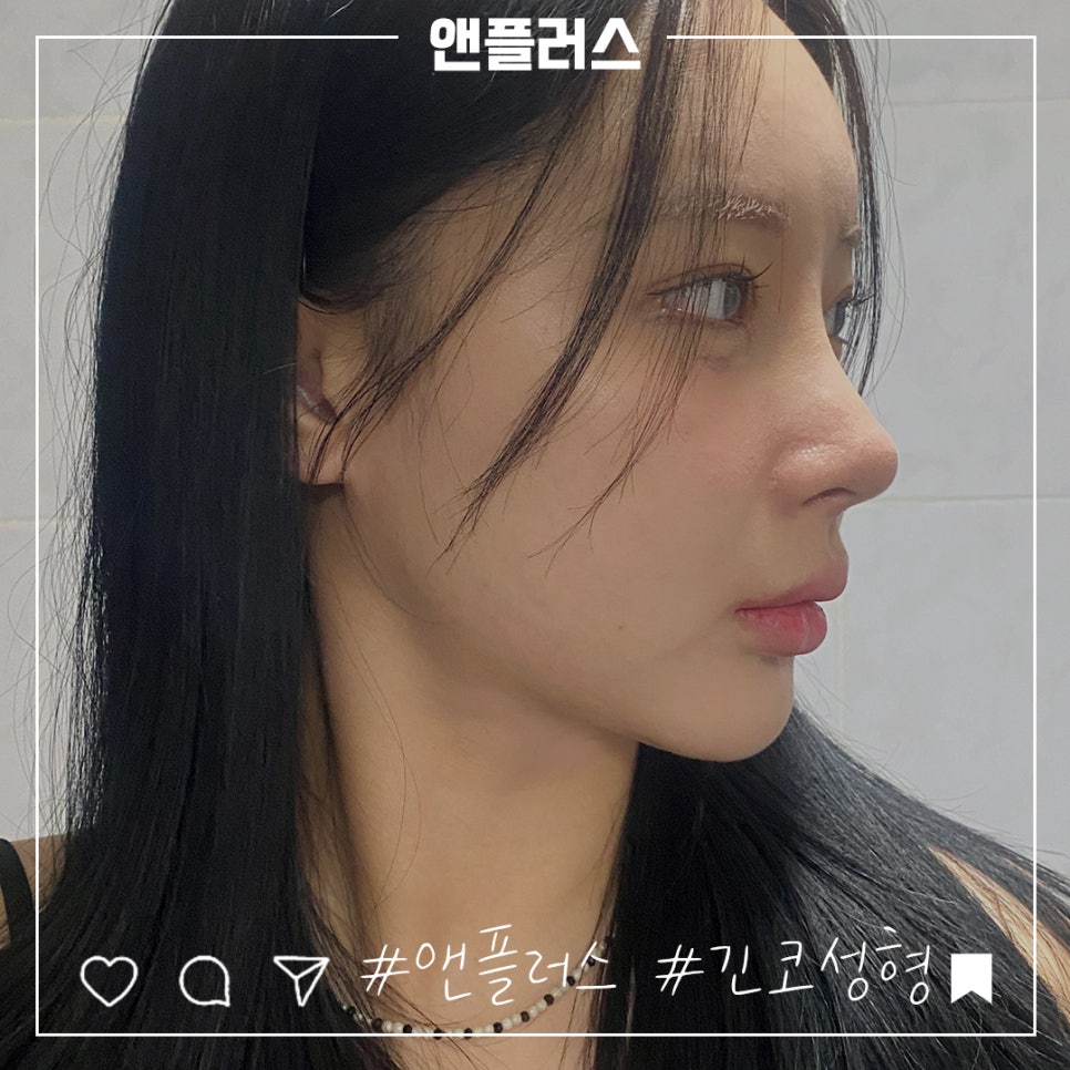 Learn More About Long Nose Surgery in Detail image 11