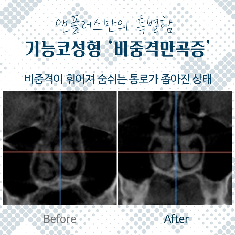 Septoplasty for Satisfying Results image 2
