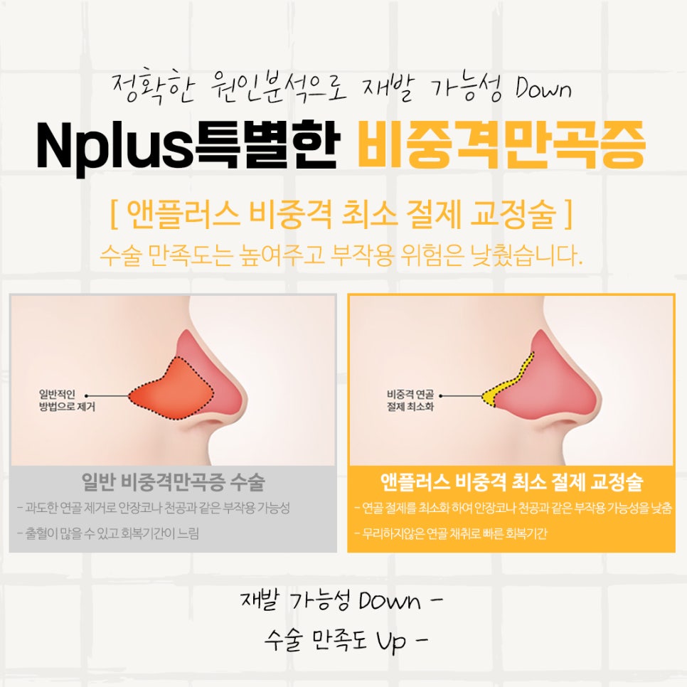 Septoplasty Surgery Review: With a Careful Decision image 11