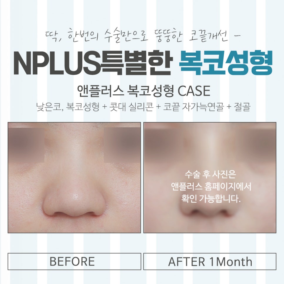 Looking Closely at Bulbous Nose Surgery Reviews image 16