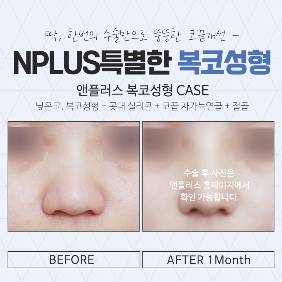 Broad Nose Surgery Review for a Refined Look image 15
