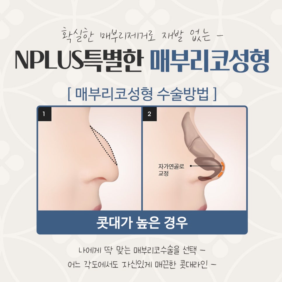 매부리코수술 후기까지 상세하게 알아보고 관련 이미지 8