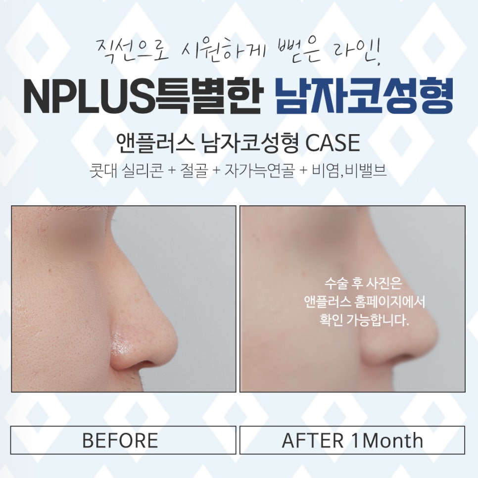 남자비염코성형 자세하게 알아보고 결정 관련 이미지 15