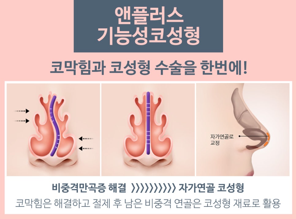 Septoplasty Surgery at N+ image 8