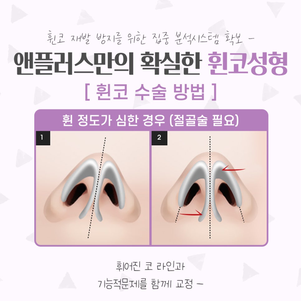 휜코성형후기 기능까지 확인해야 관련 이미지 10