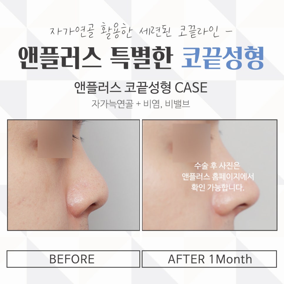 Nose Tip Surgery Review: Natural Results with Nose Tip Cartilage Stitching image 16