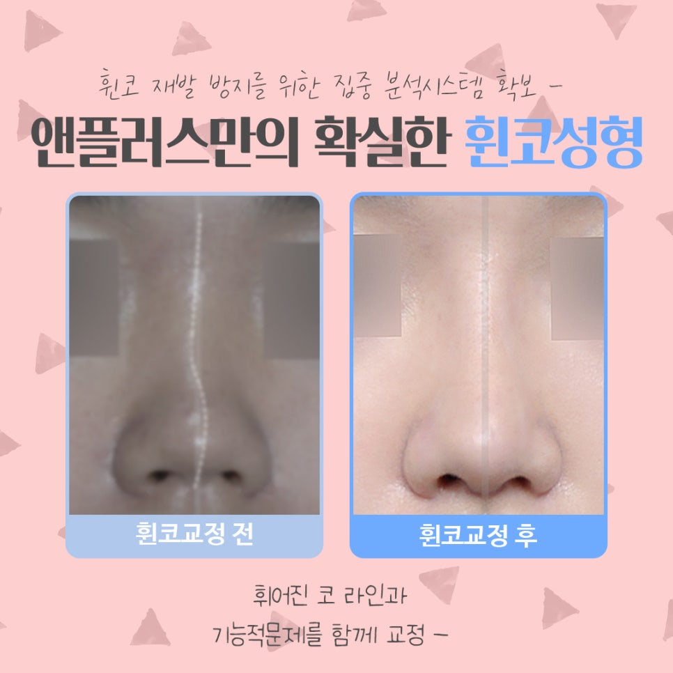 휜코수술후기 꼼꼼하게 알아보고 관련 이미지 3