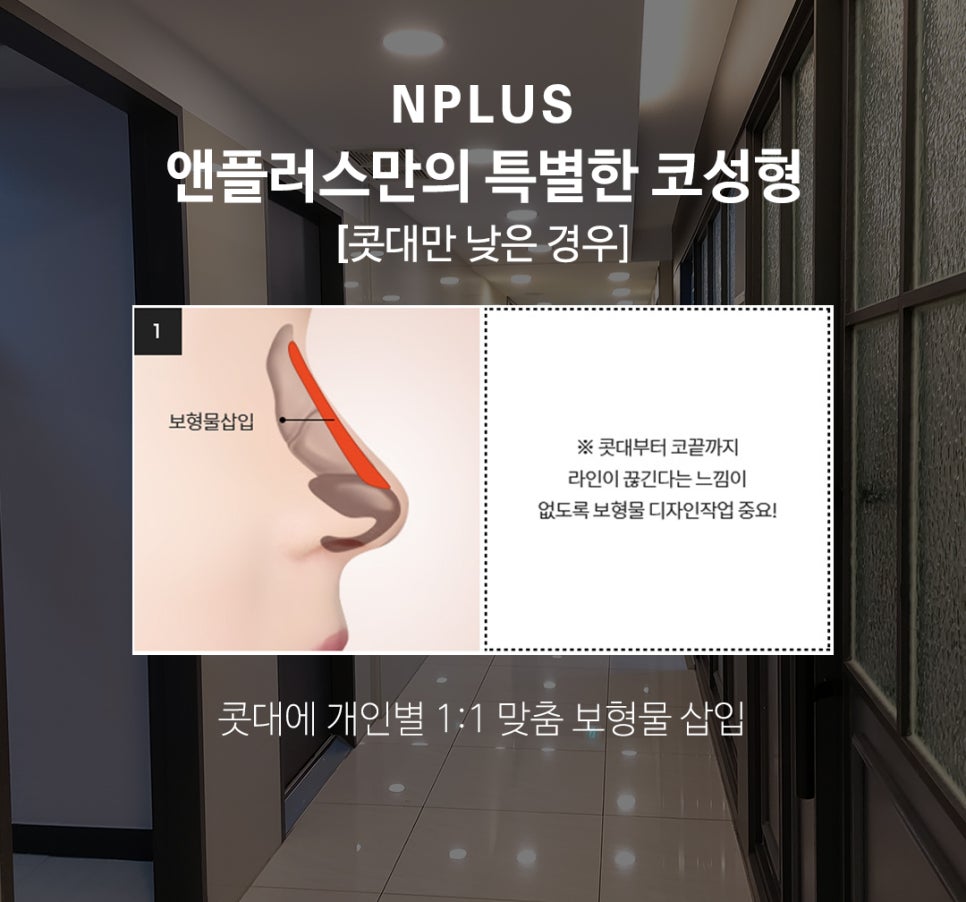 자가늑연골코성형 으로 코재수술 고민 해결 관련 이미지 4