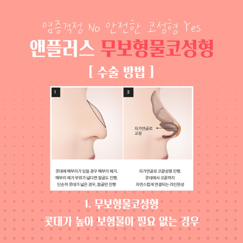 무보형물코수술 안전하고 자연스럽게 관련 이미지 6