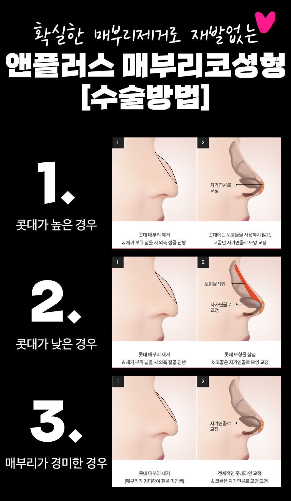 매부리코수술후기_완벽한 매부리제거로 깔끔하게 관련 이미지 5