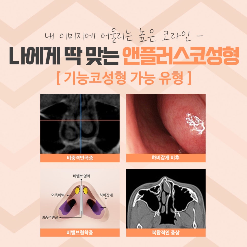 코성형 후기로 알아보고 결정 관련 이미지 6