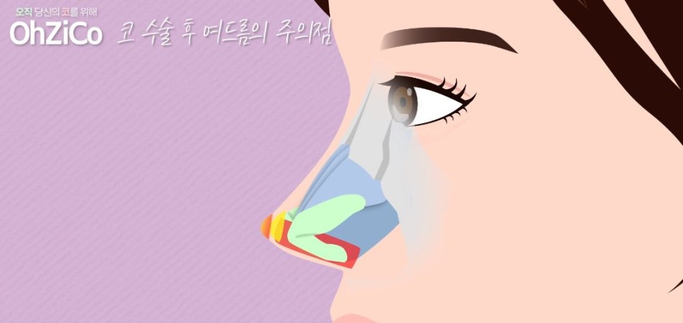 코수술후 코여드름 원인과 해결 방법 관련 이미지 15