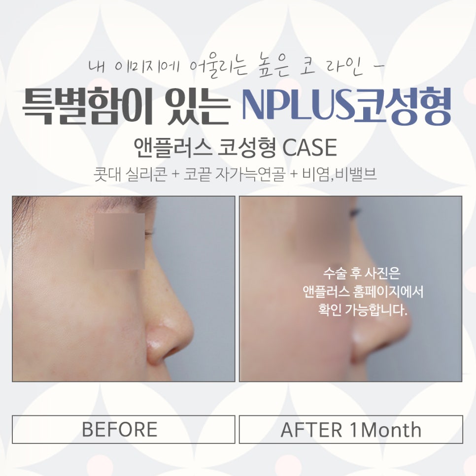 코수술후기 기능까지 확인하고 관련 이미지 15