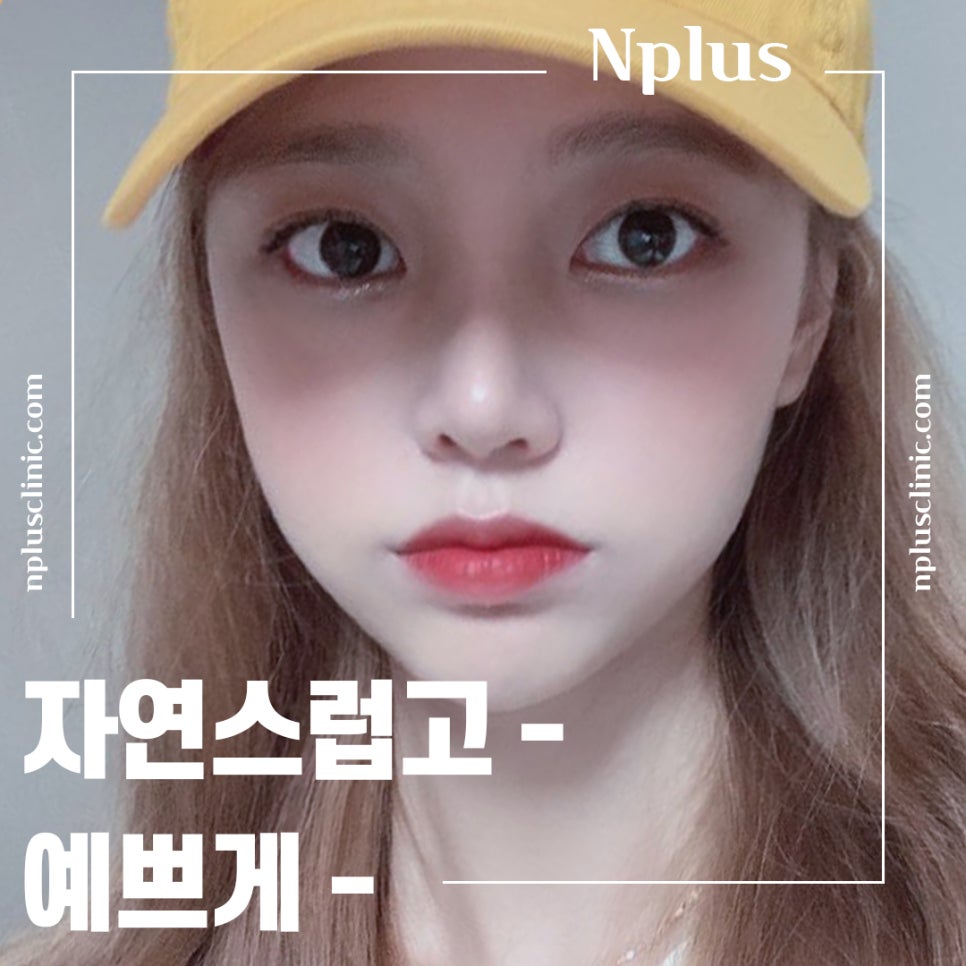 Nose Surgery Review for Correcting a Hump Nose image 3