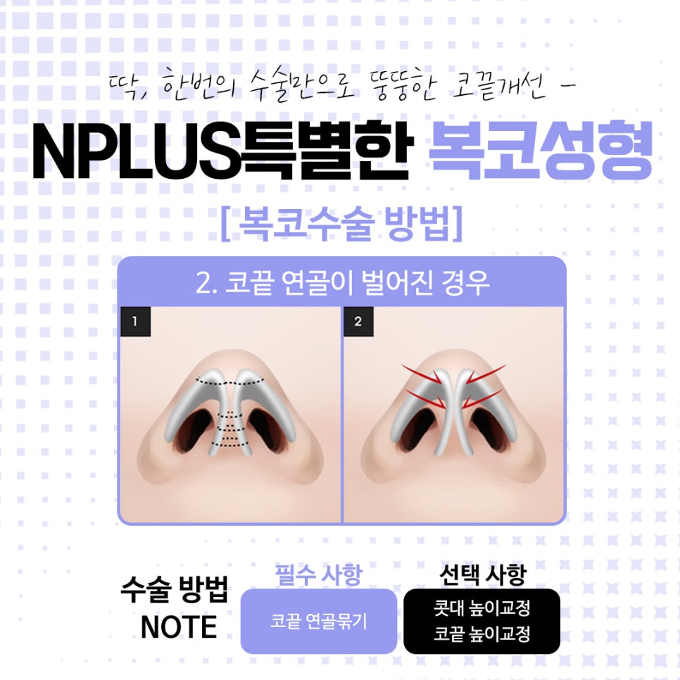 복코수술전후에 대해 자세히 찾아보고 관련 이미지 9