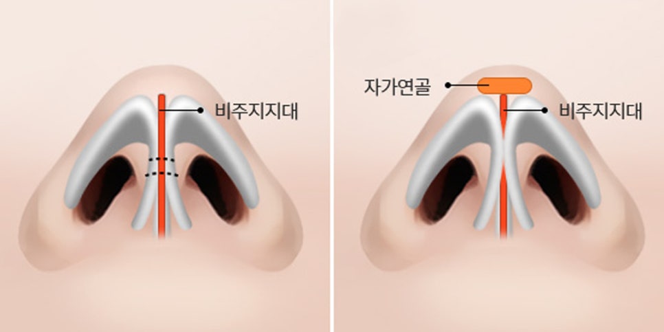 코 성형 후 보형물을 빼도 원래대로 돌아갈까? 관련 이미지 3