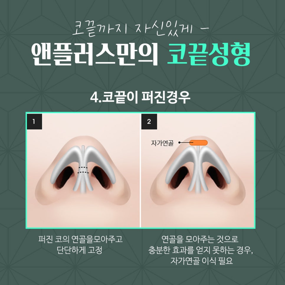 코끝연골묶기 활용한 코끝성형 관련 이미지 9