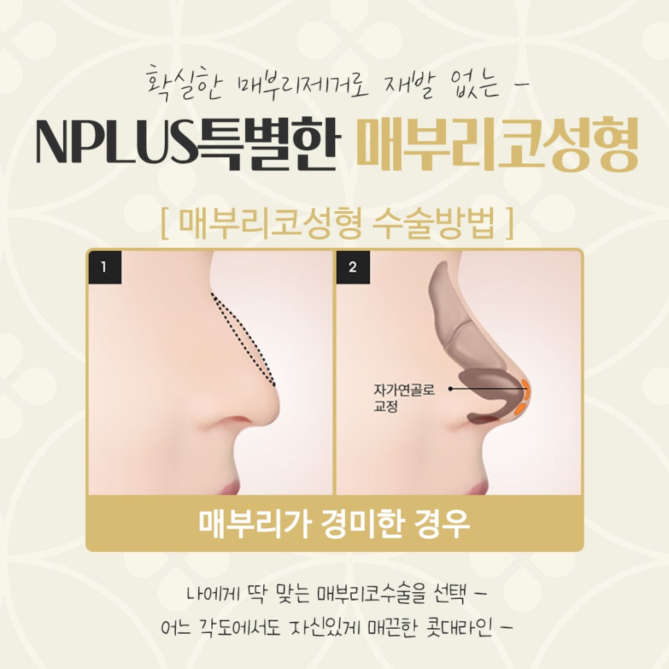 매부리코수술후기 확인하고 부드러운 인상으로 관련 이미지 12
