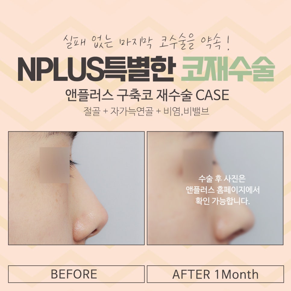 코재수술성형외과 잘 알아보고 결정해야 관련 이미지 13