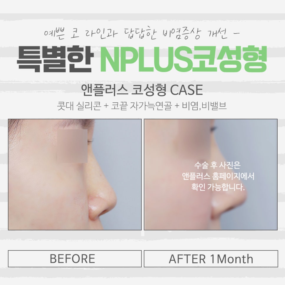 낮은코성형 후기에 대해 알아보고 관련 이미지 13