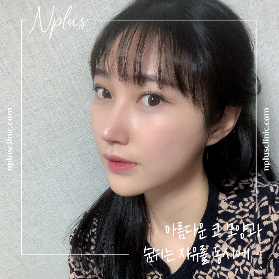 Reviewing Nostril Reduction Results and Improving Your Appearance image 4