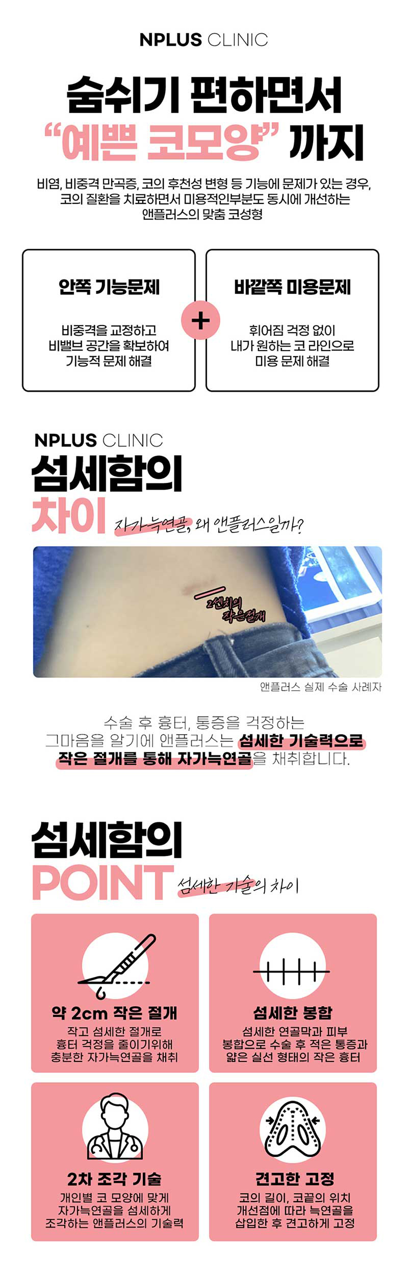 앤플러스의원 코재수술이벤트로 자연스럽고 예쁘게- 관련 이미지 6