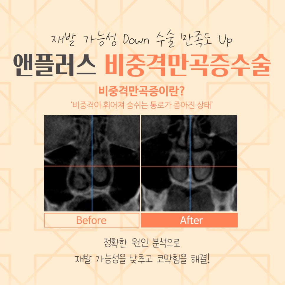비중격만곡증수술후기 코 내부를 정확하게 파악해야 관련 이미지 6