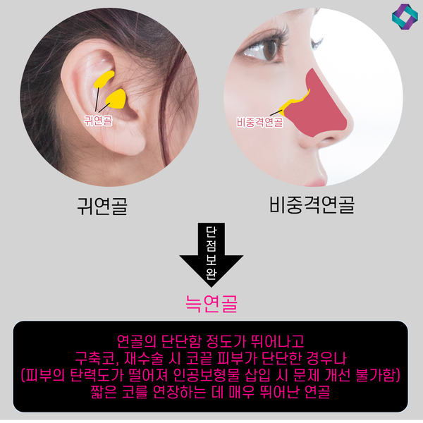 늑연골 코성형 : 자가연골의 장점과 단점 (자가연골 비교) 관련 이미지 7