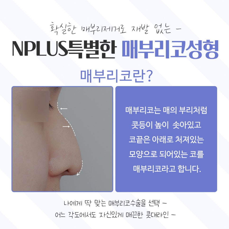 Learn About Hump Nose Surgery Reviews Accurately image 3