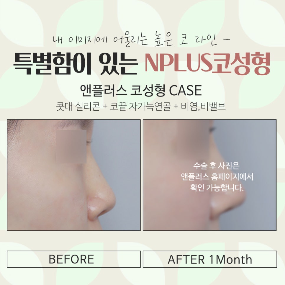 Check the Detailed Nose Surgery Review image 14