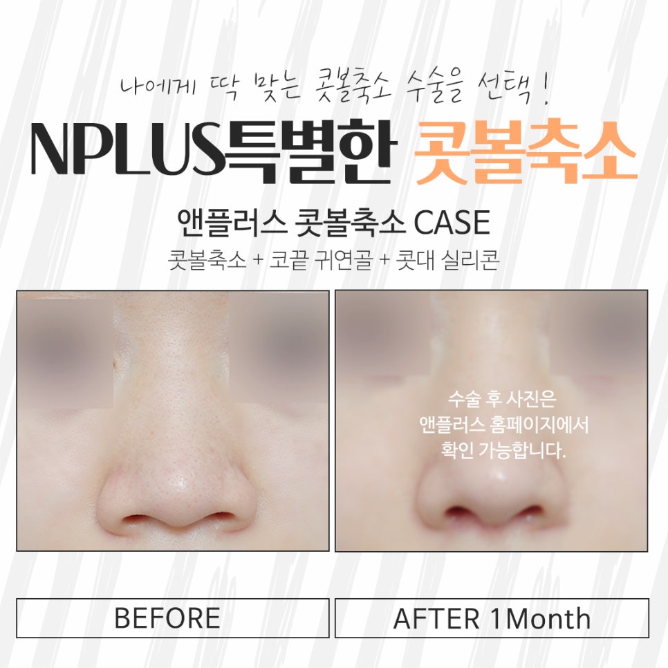 Looking into Nasal Ala Reduction Surgery Methods image 13