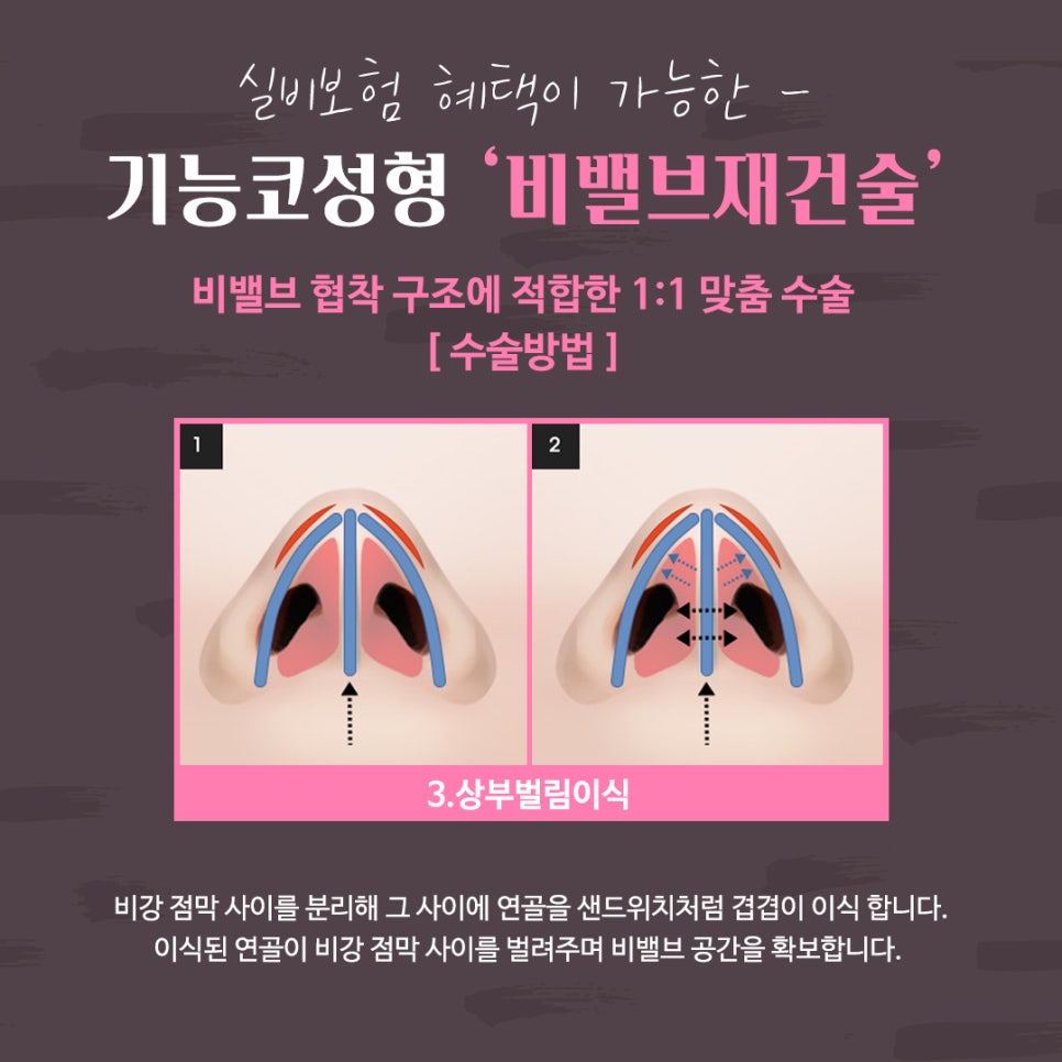 비밸브재건술 확실한 강남앤플러스에서 관련 이미지 12