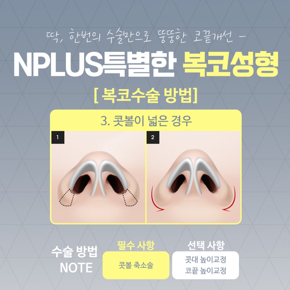 복코수술후기 조화로운 얼굴 라인 관련 이미지 8