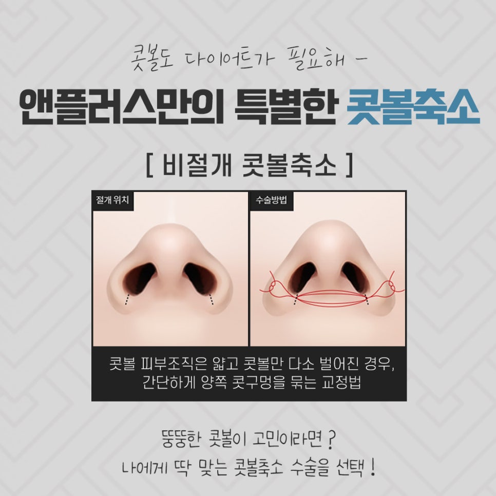 Reviewing Nostril Reduction Results and Improving Your Appearance image 9
