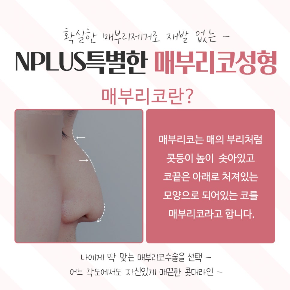 Taking a Detailed Look at Hump Nose Surgery Reviews image 3