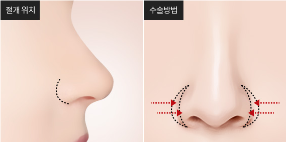 콧볼축소수술 꼭 안해도 되는 경우와 흉터 안 남는 방법? 관련 이미지 5
