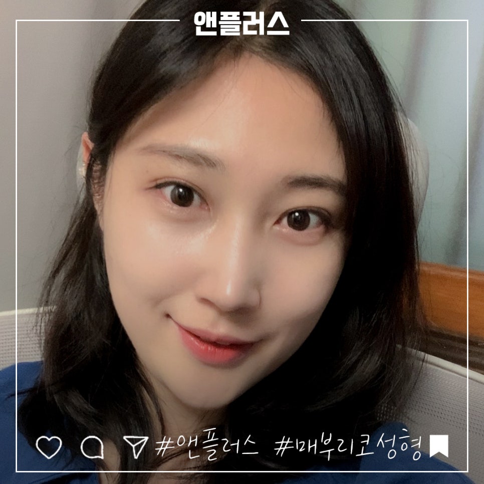 매부리코성형후기 꼼꼼하게 알아보고 관련 이미지 2