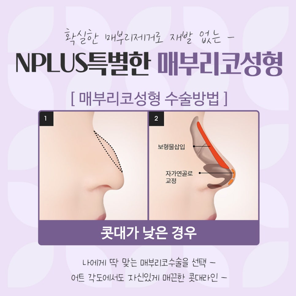 Check the Hump Nose Surgery Review in Detail image 9