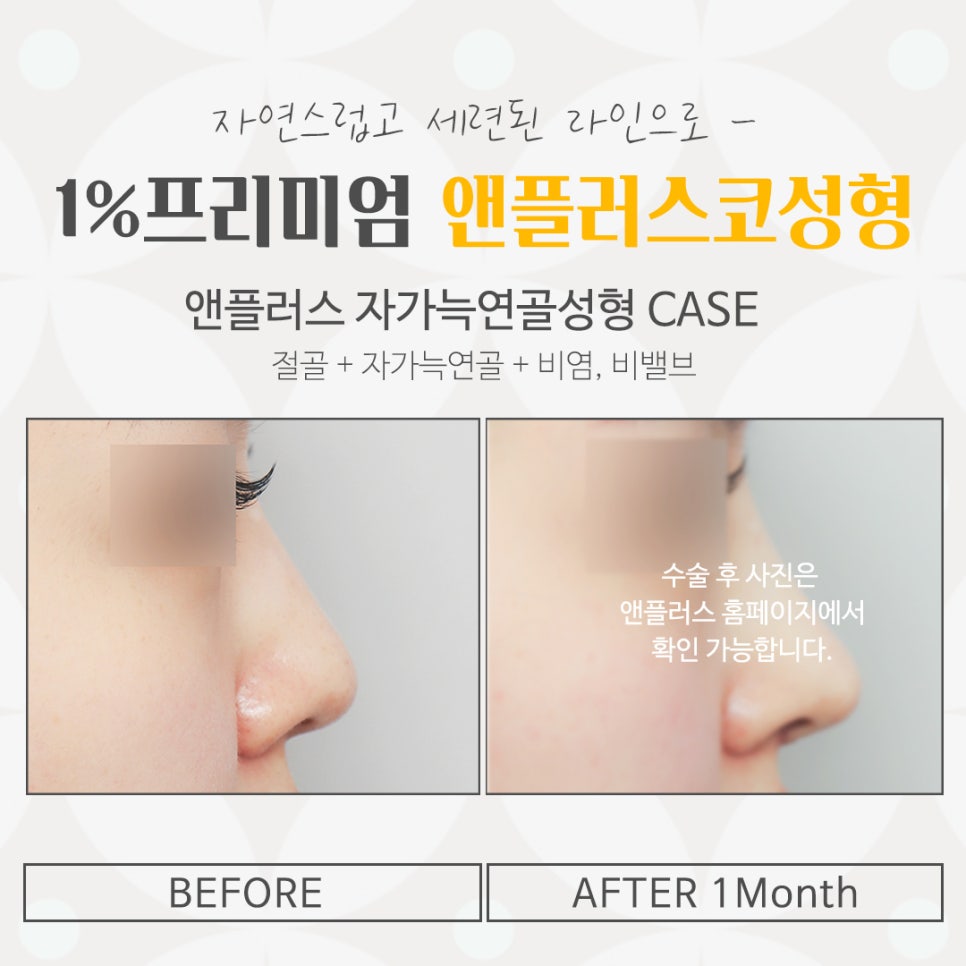자가늑연골코성형의 필요성 관련 이미지 15
